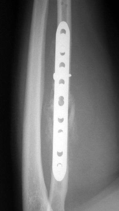 Radius & Ulna, Shaft:  Synthes LCP (Implant 262)